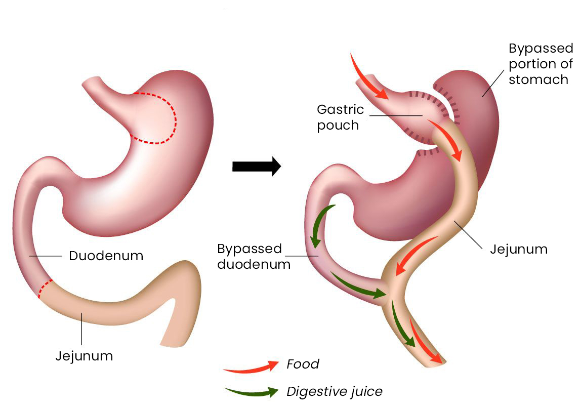 gastric bypass Melbourne